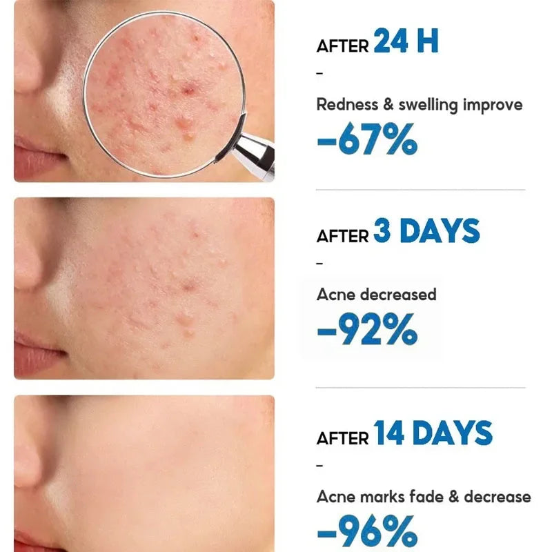 Salicylic Acid Acne Relief Cream™