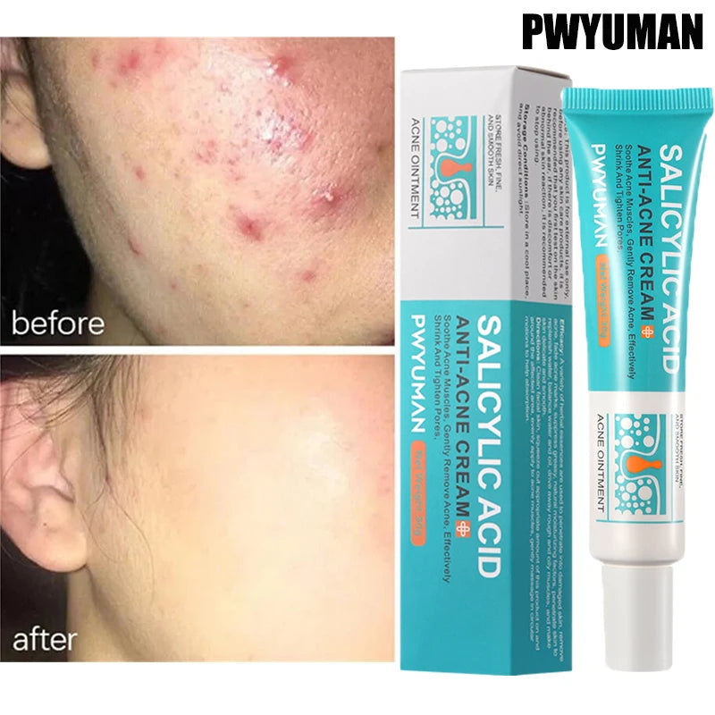 Salicylic Acid Acne Relief Cream™