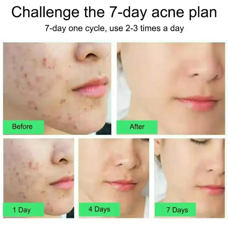 Salicylic Acid Acne Relief Cream™