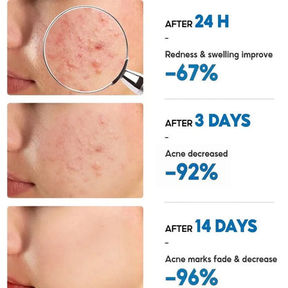 Salicylic Acid Acne Relief Cream™
