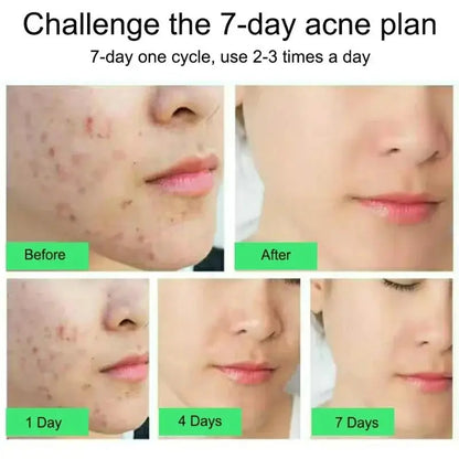 Salicylic Acid Acne Relief Cream™