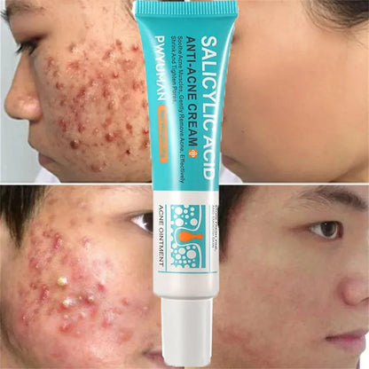 Salicylic Acid Acne Relief Cream™